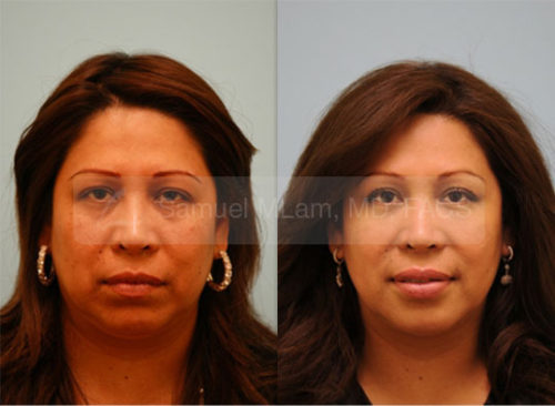 Lam facial plastic