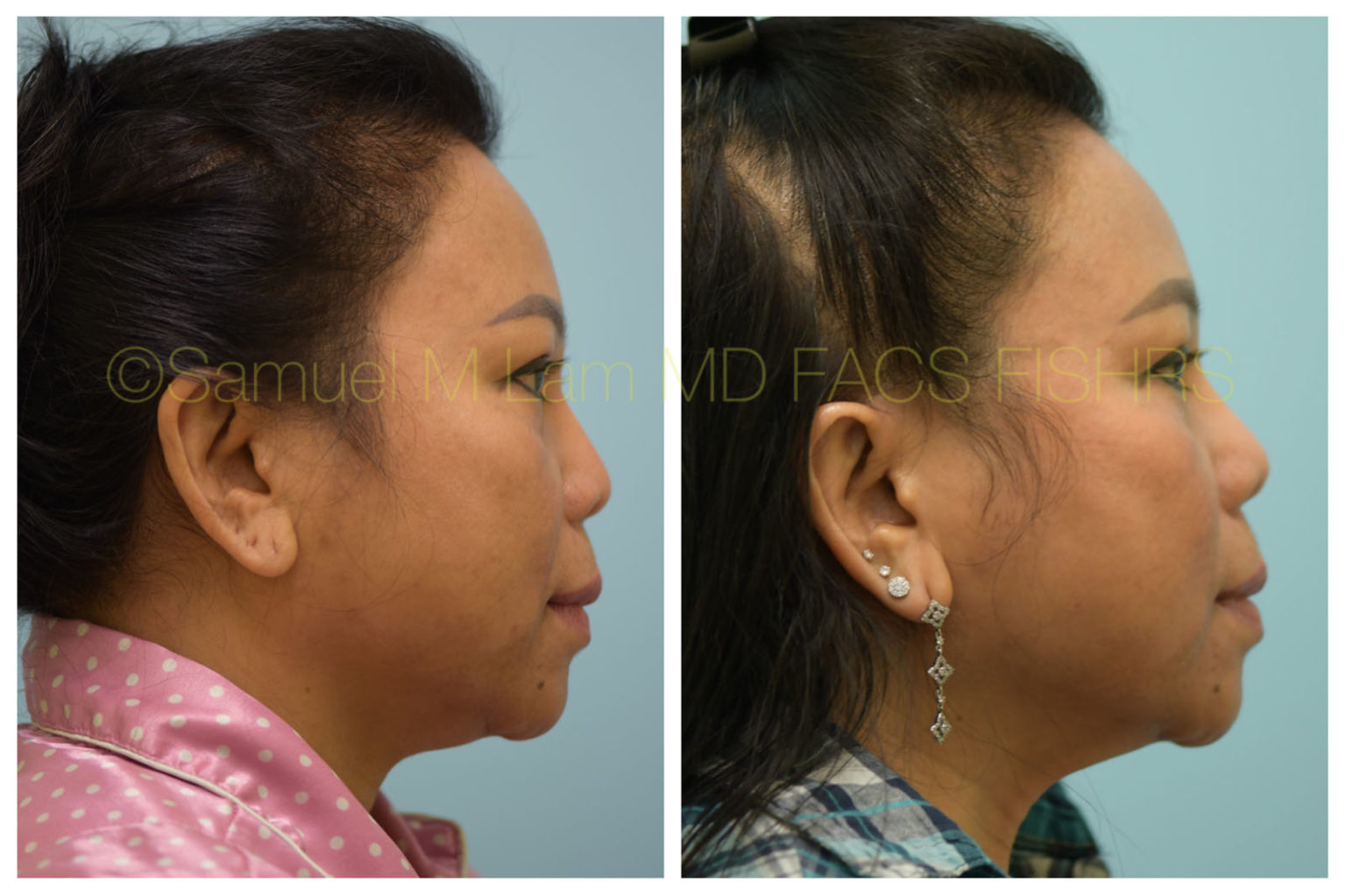 Dallas Revision Corrective Rhinoplasty Before And After Photos Plano