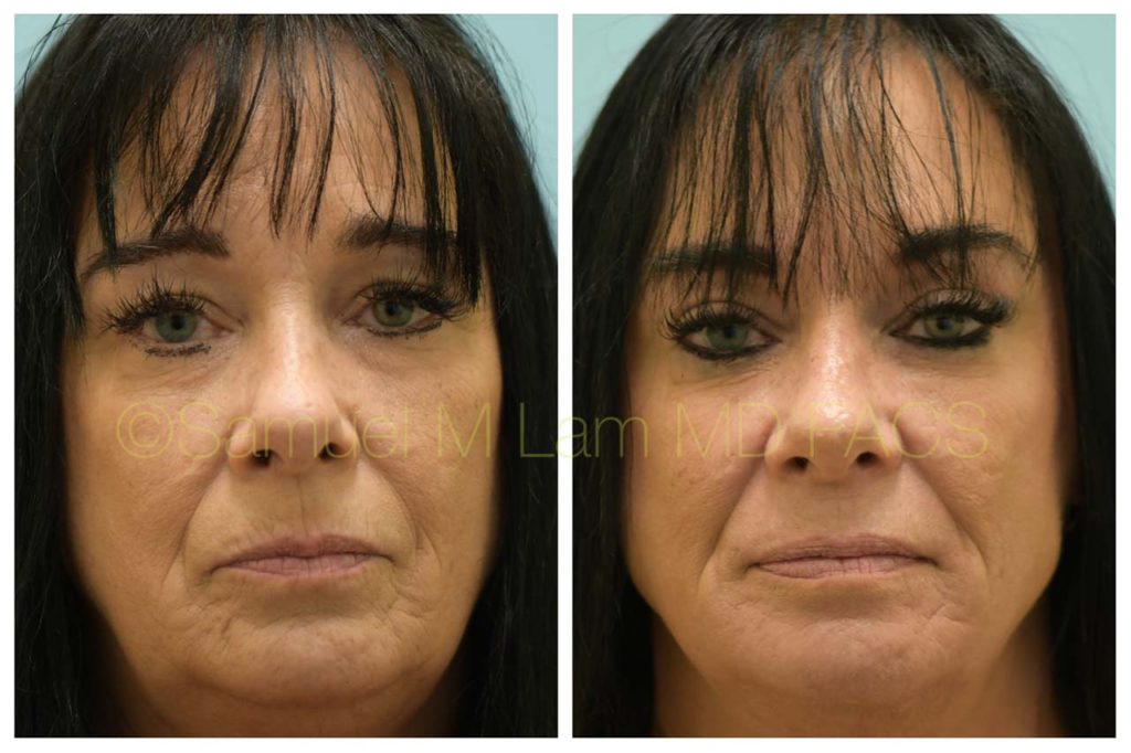 Dallas Skin Resurfacing Before And After Photos Plano Plastic Surgery