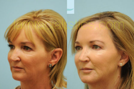 Advanced Laser Skin Resurfacing in Central TX – Facial Plastic Surgery of  Central Texas