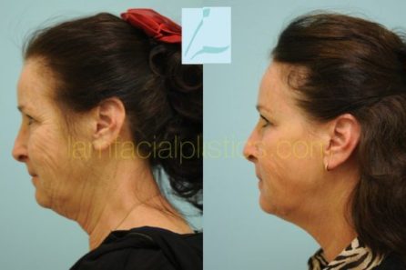 Advanced Laser Skin Resurfacing in Central TX – Facial Plastic Surgery of  Central Texas
