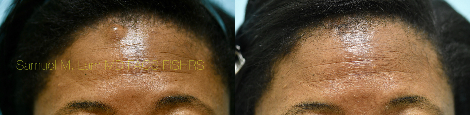 Mole Removal Before and After Photo by Dr. Lam in Plano, TX