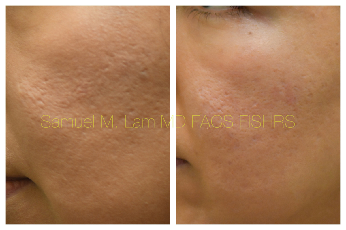 Acne Scarring Before and After Photo by Dr. Lam in Plano, TX