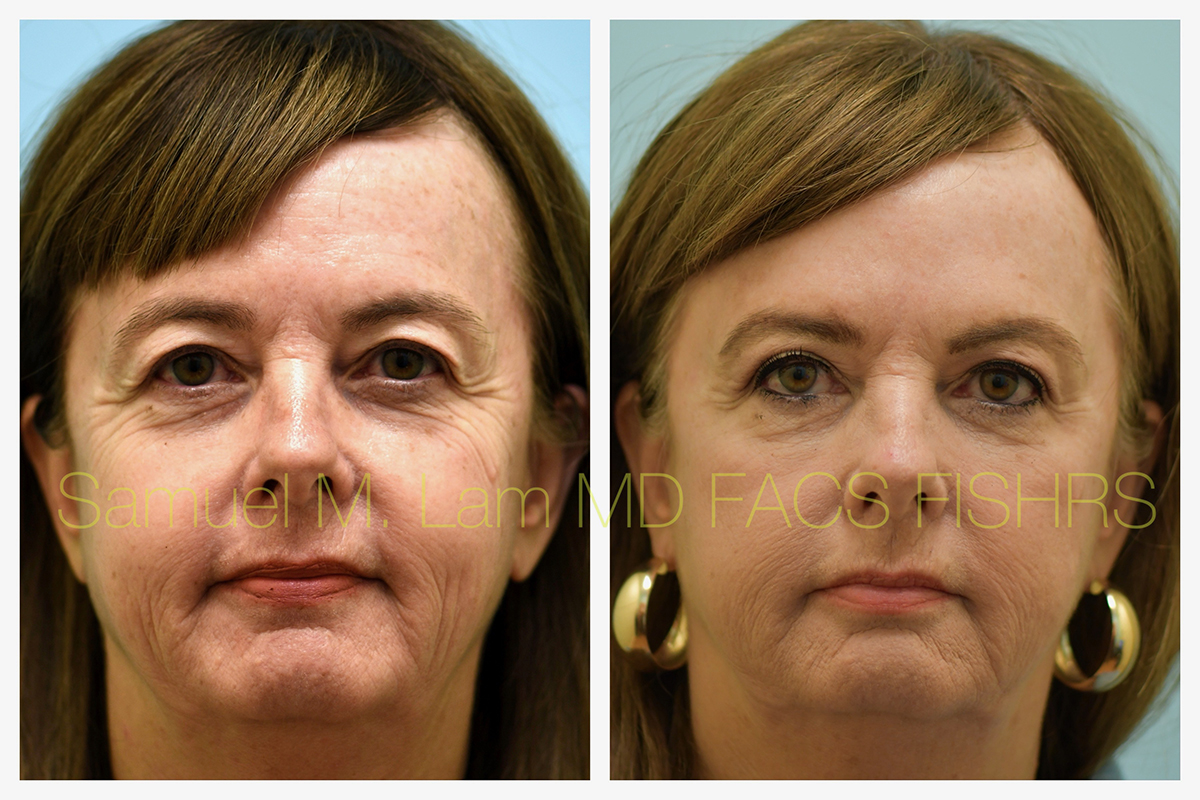 Eyelid Rejuvenation, Botox, and Fillers Before and After Photo by Dr. Lam in Plano, TX