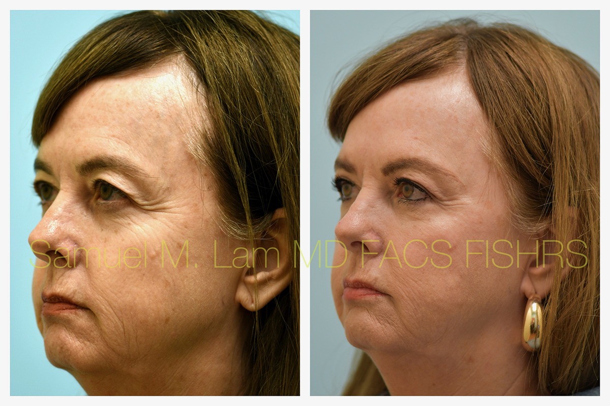 Eyelid Rejuvenation, Botox, and Fillers Before and After Photo by Dr. Lam in Plano, TX