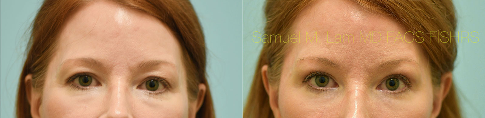 blepharoplasty and fat grafting