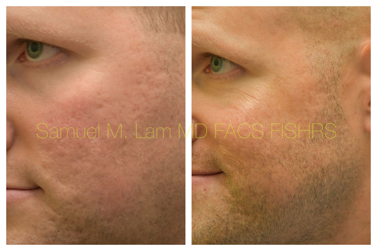 Acne Scarring and MesoBotox Before and After Photo by Dr. Lam in Plano, TX