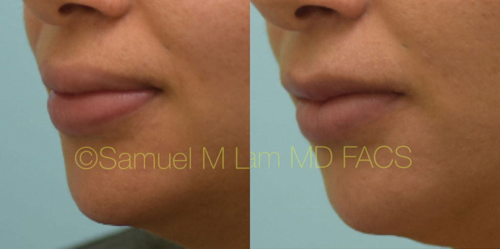 Dallas Lip Reduction Corrective And Ethnic Before And After Photos Plano Plastic Surgery 