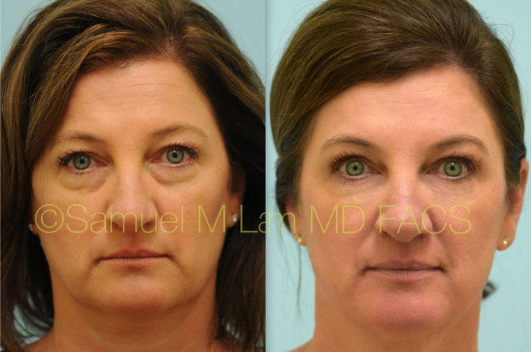 Dallas Kybella Before And After Photos Plano Plastic Surgery Photo Gallery Dr Sam