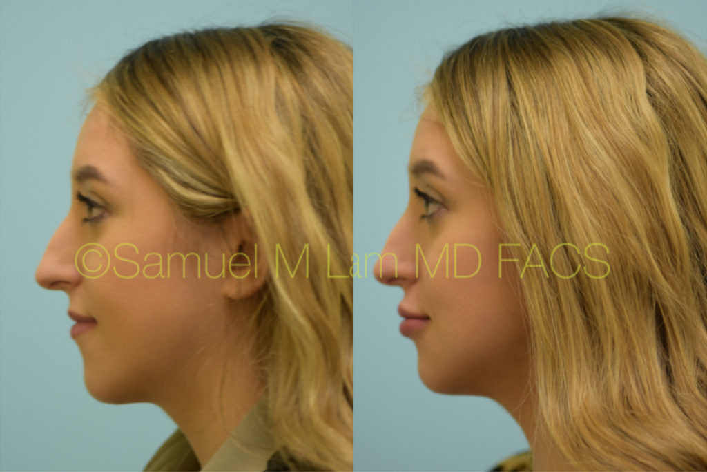 Dallas Injectable Fillers Before And After Photos Plano Plastic Surgery Photo Gallery Dr