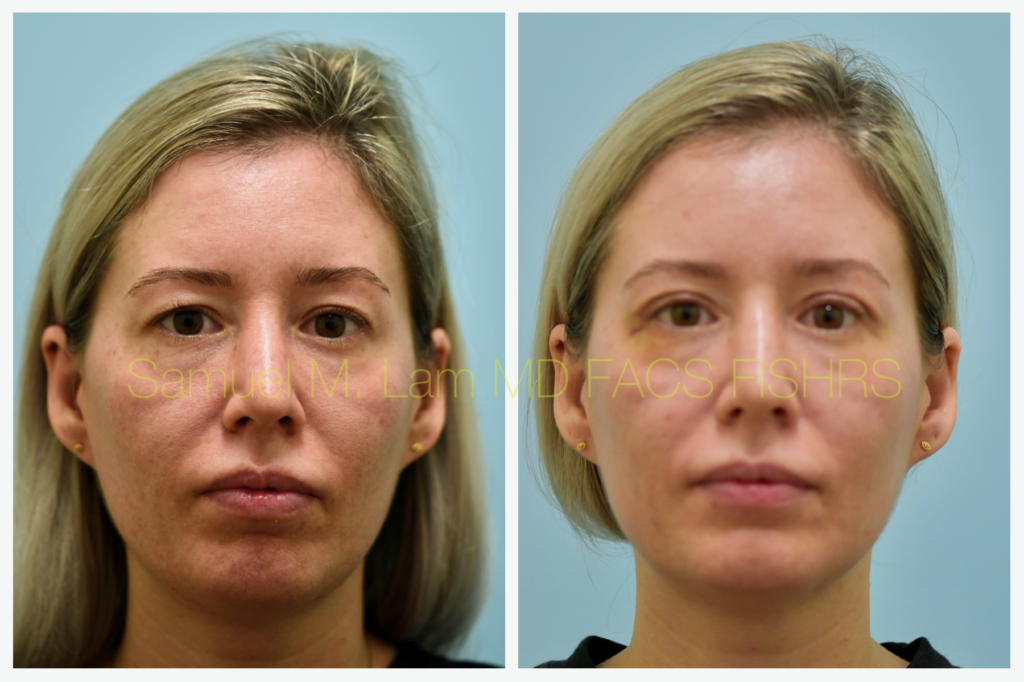 Dallas Blepharoplasty Before and After Photos - Plano Plastic Surgery ...