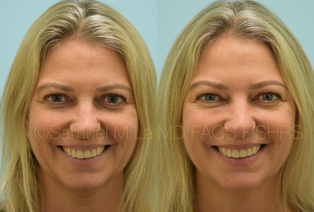 Dallas Botox Before And After Photos Plano Plastic Surgery Photo Gallery Dr Sam LamBotox