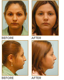 Crooked Nose Rhinoplasty Dallas, Twisted Nose Surgery Plano, TX