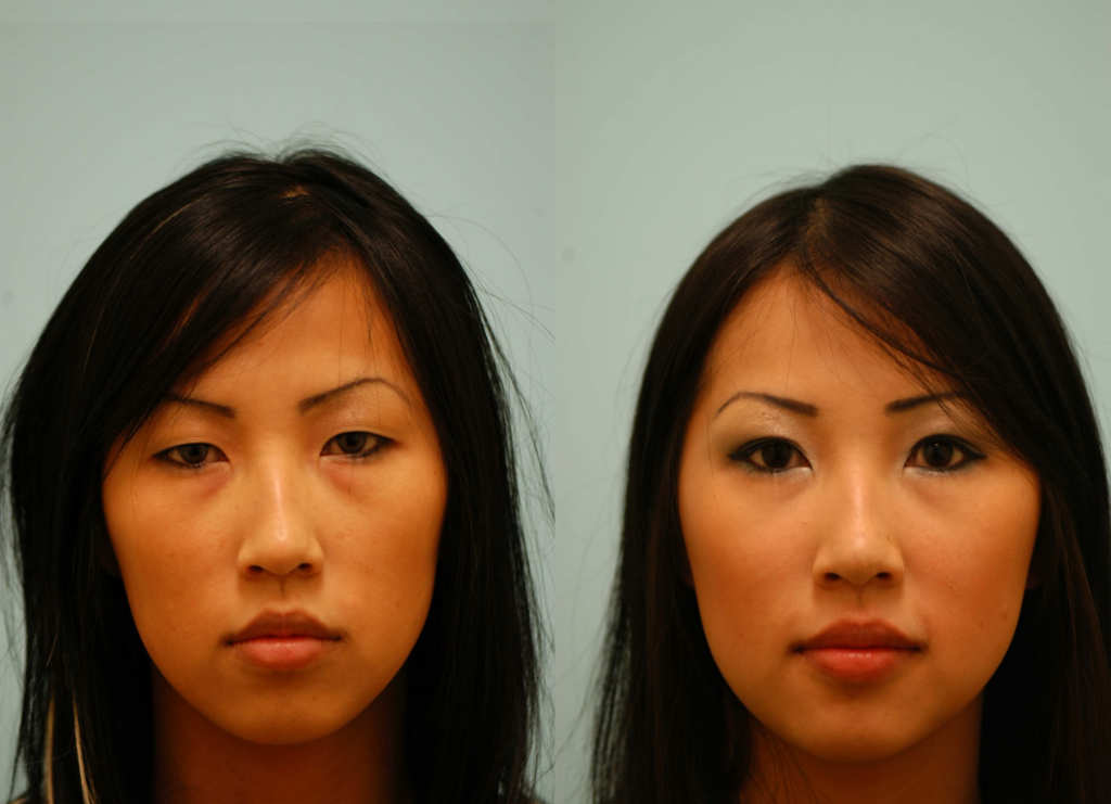 Why Asian Eyelids Can Be More Easily Made Symmetrical Lam Facial