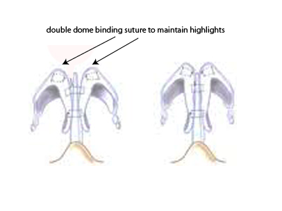 Understanding Double Dome Highlights In Rhinoplasty Lam Facial Plastic Surgery Center