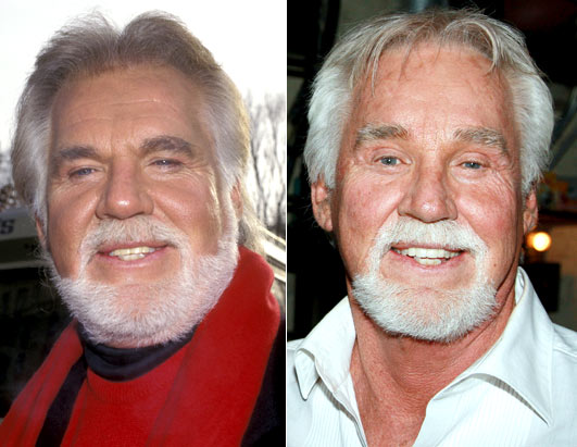 Kenny Rogers And Bad Blepharoplasty And Browlift Surgery